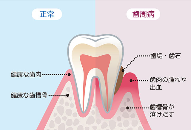 歯周病